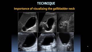 Basic Gallbladder [upl. by Ardnuhsed]