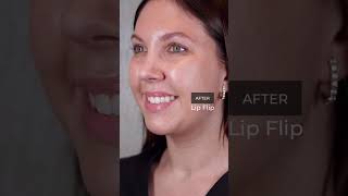 Lip Flip Before and After  Dr Paul Nassif [upl. by Attennaj]