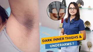 Dark Inner Thighs amp Underarms  Dr Deepika Lunawat [upl. by Affer440]