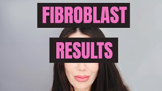 Fibroblast Treatment Results [upl. by Munshi614]