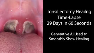 Healing Time Lapse After Tonsillectomy 029 Days in 60 Seconds [upl. by Resa290]