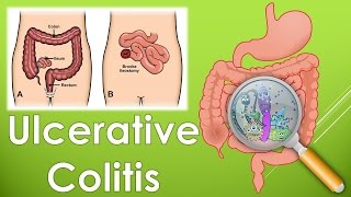 What is an Ulcerative Colitis What are the symptoms of Ulcerative Colitis [upl. by Sirdi]