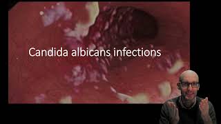 Candida albicans infections [upl. by Liggett]