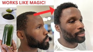 😱His Hairline Started Receding Until He Tried This Used it only 2x A Week And Watch His Hairline [upl. by Martie391]