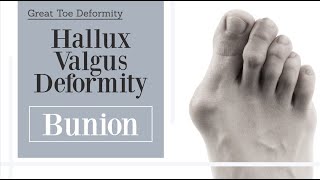 Bunion  hallux valgus big toe deformity [upl. by Reeves192]