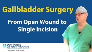 Gallbladder Surgery From Open Wound to Single Incision [upl. by Maxi]