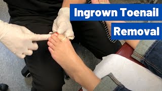 Ingrown Toenail Removal Surgery Video  Permanent Cosmetic Procedure [upl. by Nannek]