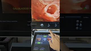 Gallbladder Polyp 3d Ultrasound [upl. by Tadich685]