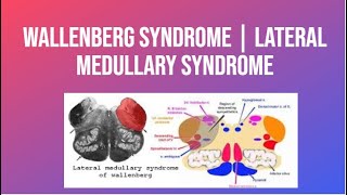 Wallenberg Syndrome  Lateral Medullary Syndrome  PhysiotherapyKnowledge [upl. by Wilterdink246]