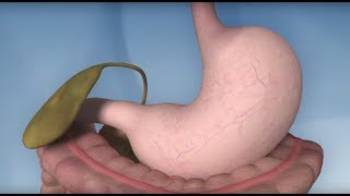 Gastric Bypass Complications  Mayo Clinic [upl. by Ecirtnahc290]