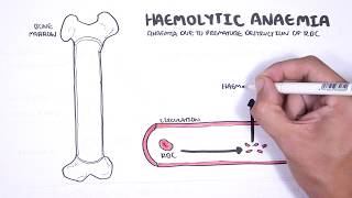 Haemolytic Anaemia  classification intravascular extravascular pathophysiology investigations [upl. by Helse]