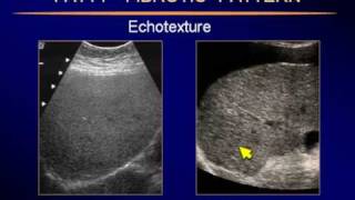 Sonography of the LiverP5flv [upl. by Simah]