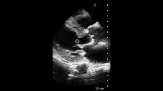 Concentric Left Ventricular Hypertrophy LVH  Ultrasound Image Interpretation [upl. by Neitsirk714]