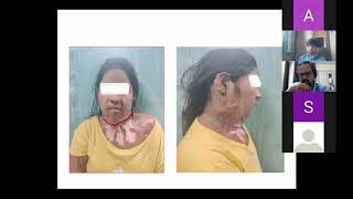 Plastiquest Case Discussion  Post Burn Contracture Neck  Part 2 [upl. by Nosylla168]