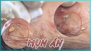 Big Cystic Acne Blackheads Extraction Blackheads amp Milia Whiteheads Removal Pimple Popping [upl. by Sonahpets655]