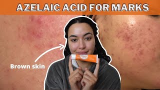 How to use Skinoren cream  Effects amp Side effects  what is Azelaic acid  Magic cream [upl. by Potter757]