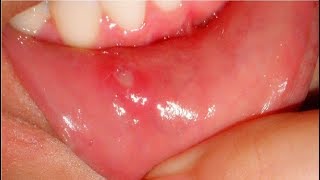 how to get rid of canker sores in minutes [upl. by Anaizit638]