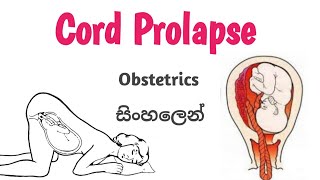 Cord Prolapse [upl. by Einor]