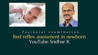 Red reflex in newborn How to test why is it important Dr Sridhar K [upl. by Telracs]