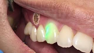 Canker sore removal [upl. by Nylevol]