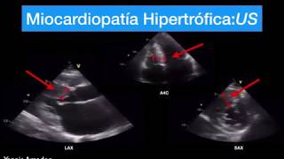 Miocardiopatía Hipertrófica Fácil 1 mecanismo [upl. by Odyssey]