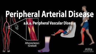 Peripheral artery disease Pathophysiology Causes Symptoms Diagnosis and Treatments Animation [upl. by Gault]