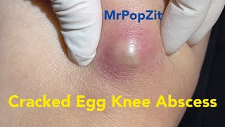 Cracked Egg Knee Abscess Large mass on knee under pressure and painful Pressure relieved [upl. by Yraeg]