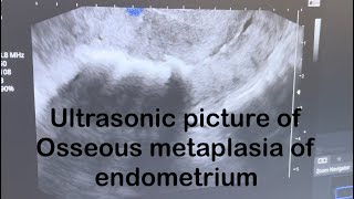 Ultrasound picture of Osseous metaplasia of endometrium [upl. by Ordnagela]