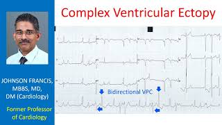 Complex Ventricular Ectopy [upl. by Decamp]