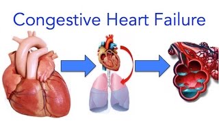 Congestive Heart Failure CHF Explained  MADE EASY [upl. by Yesnil31]